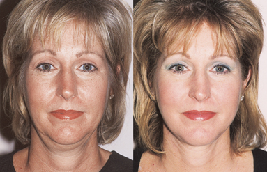 Facelift Houston Rhytidectomy The Woodlands Facial Plastic Surgery